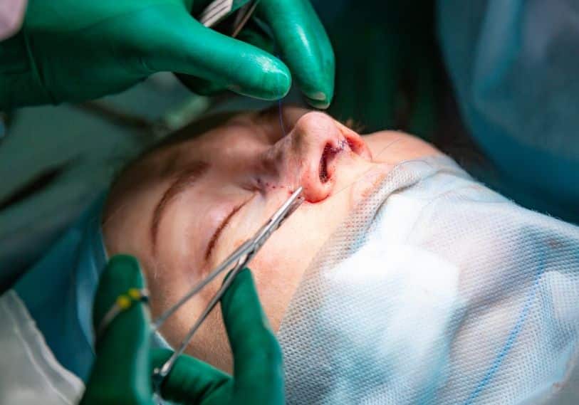 open rhinoplasty คือ