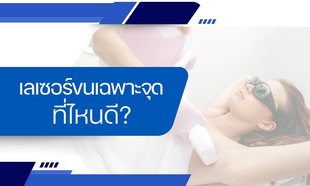 เลเซอร์ขนเฉพาะจุด ที่ไหนดี