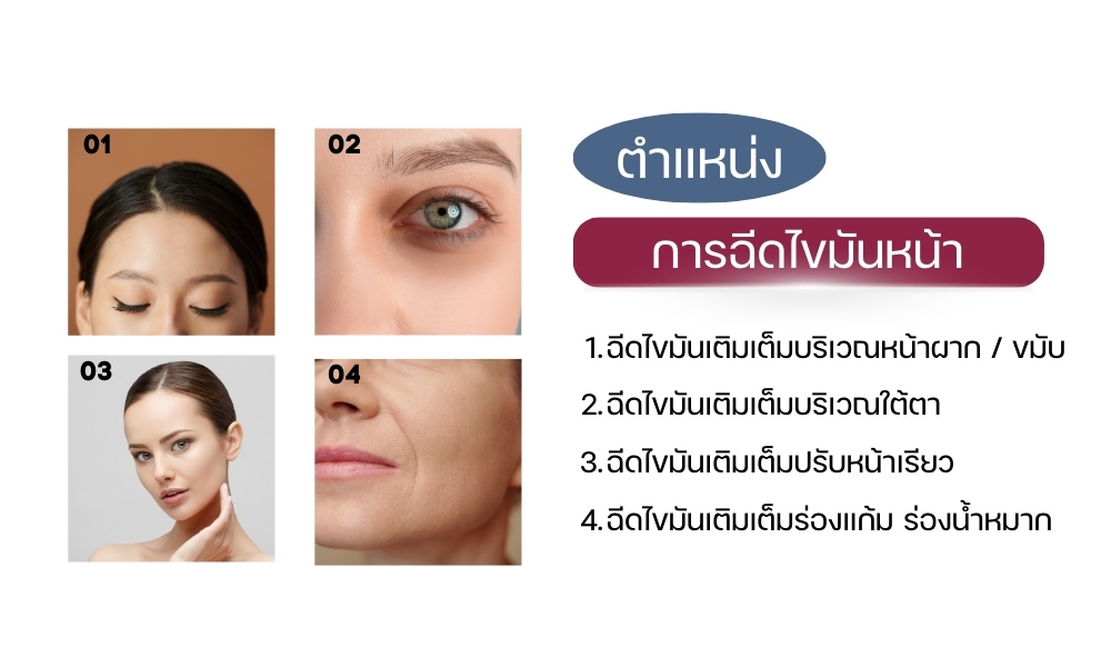 ตำแหน่งการ ฉีดไขมันหน้า