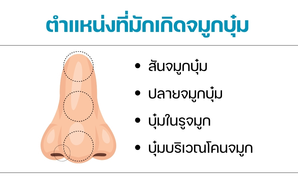 ตำแหน่งที่มักเกิดจมูกบุ๋ม