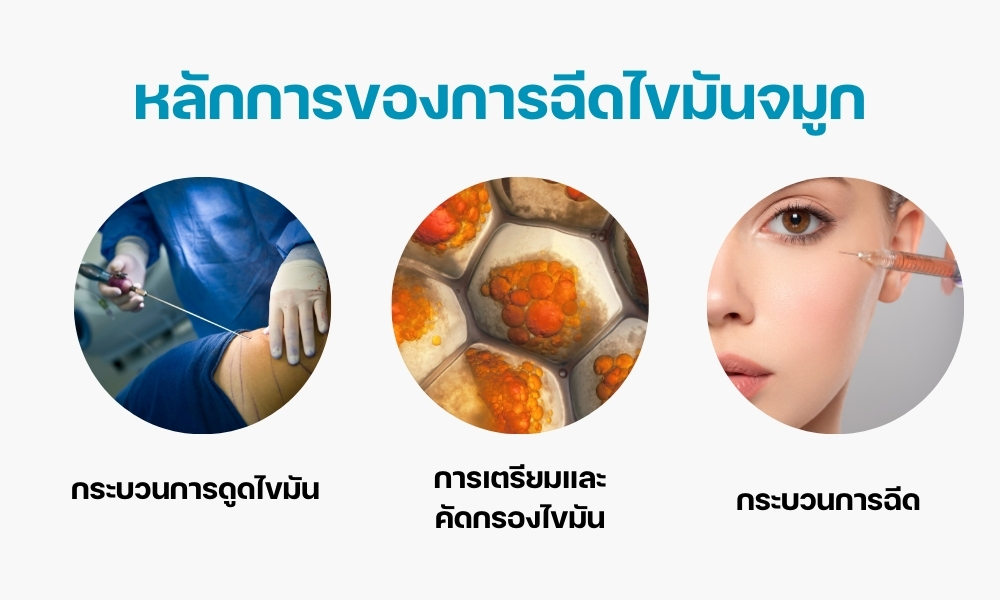 หลักการของการฉีดไขมันจมูก