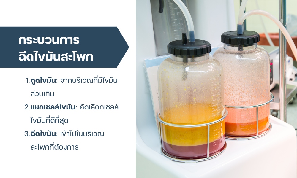 การฉีดไขมันสะโพก