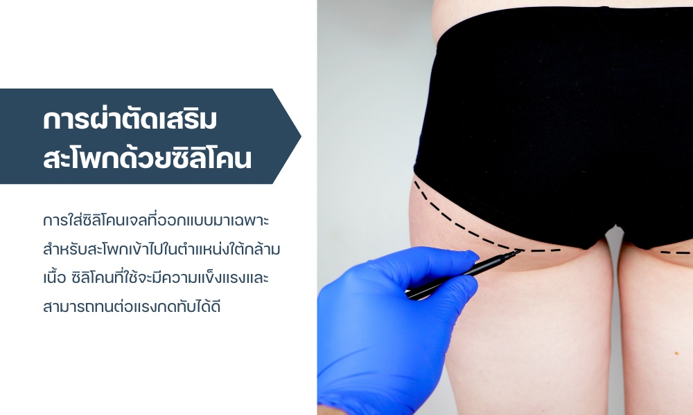การผ่าตัดเสริมสะโพกด้วยซิลิโคน