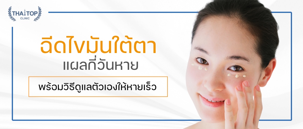 ฉีดไขมันใต้ตา แผลกี่วันหาย พร้อมวิธีดูแลตัวเองให้หายเร็ว