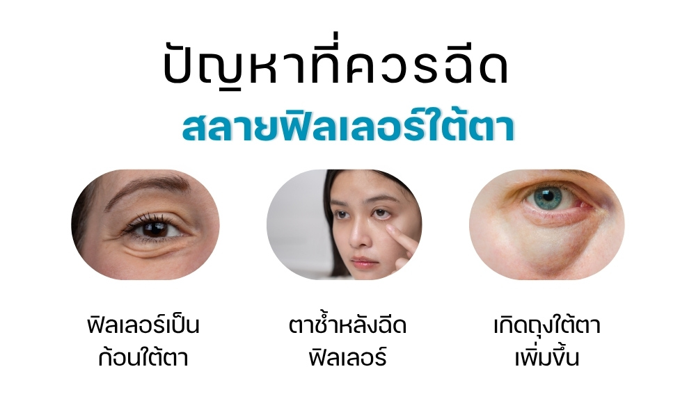 ปัญหาที่ควรฉีด สลายฟิลเลอร์ใต้ตา