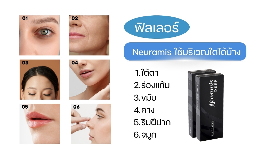 ฟิลเลอร์ Neuramis ใช้บริเวณใดได้บ้าง