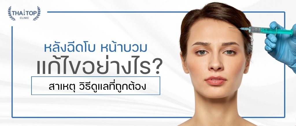 หลังฉีดโบ หน้าบวม แก้ไขอย่างไร? | สาเหตุ วิธีดูแลที่ถูกต้อง