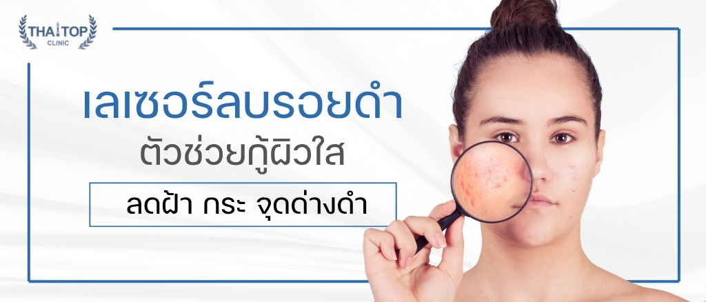 เลเซอร์ลบรอยดำ ตัวช่วยกู้ผิวใส ลดฝ้า กระ จุดด่างดำ