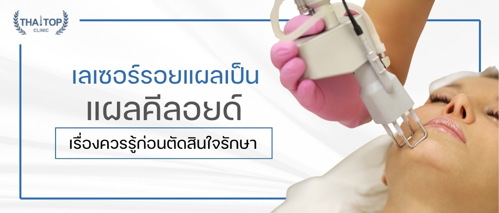 เลเซอร์รอยแผลเป็น แผลคีลอยด์ เรื่องควรรู้ก่อนตัดสินใจรักษา