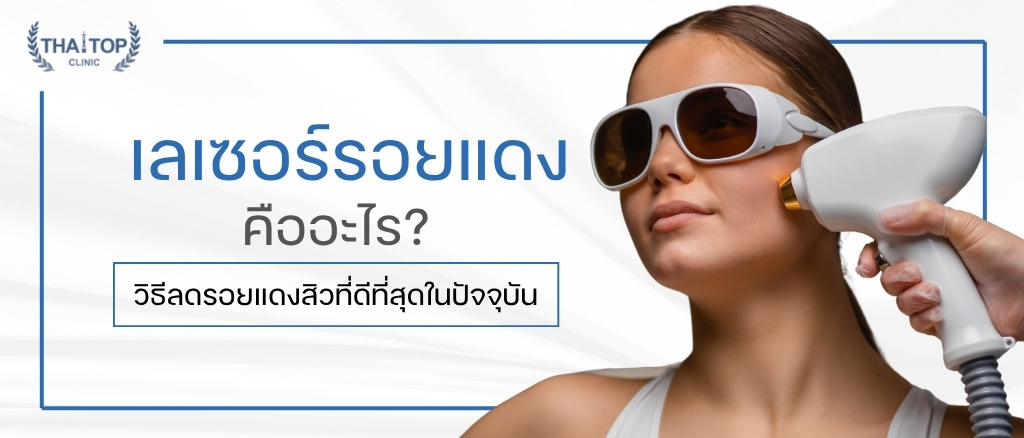 เลเซอร์รอยแดง