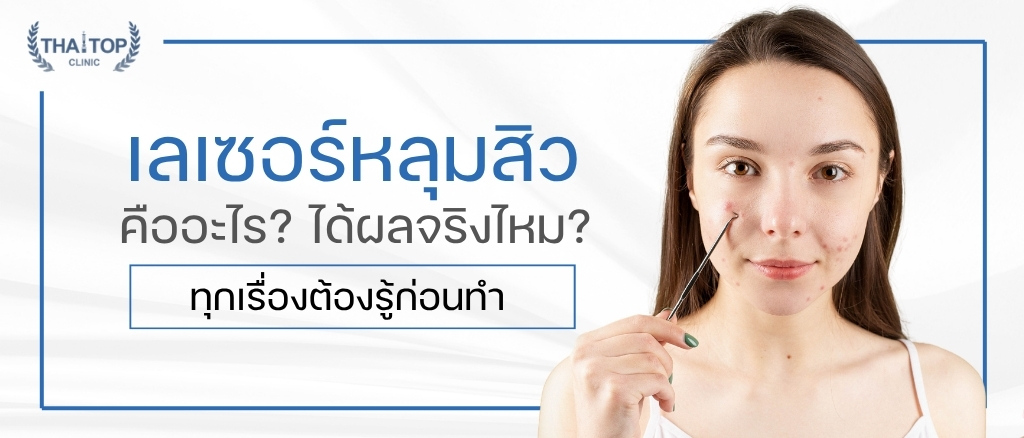 เลเซอร์หลุมสิว คืออะไร ได้ผลจริงไหม?