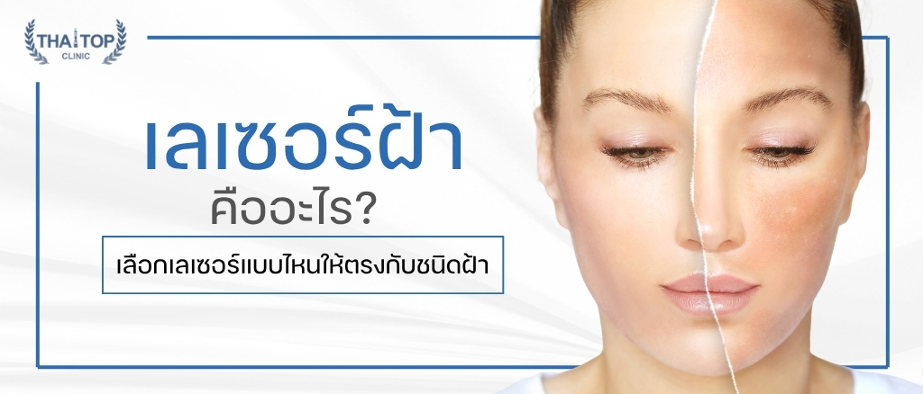 เลเซอร์ฝ้า คืออะไร