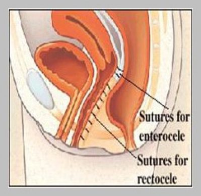 sutures-for-rectocele